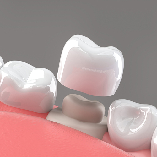 تركيبات الاسنان